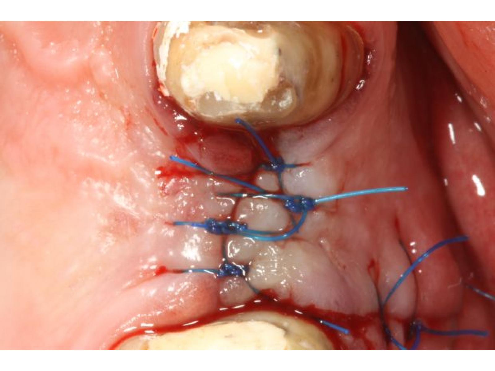 Clinica Dr. Dragus - Implant_3R.jpg