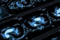 Factori de risc pentru anevrismul aortic toracic