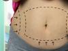 Abdominoplastia, solutia rapida pentru un abdomen atractiv