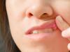 Aftele bucale - de ce apar si cum se pot trata