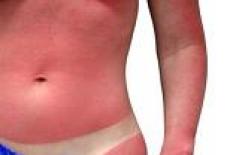 Arsurile solare: remedii din popor