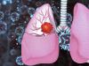 Cancerul pulmonar, ucigasul nr. 1