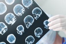 Hipoxia cerebrala sau privarea de oxigen a creierului