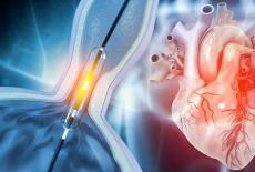 Reguli de urmat dupa implantul de stent